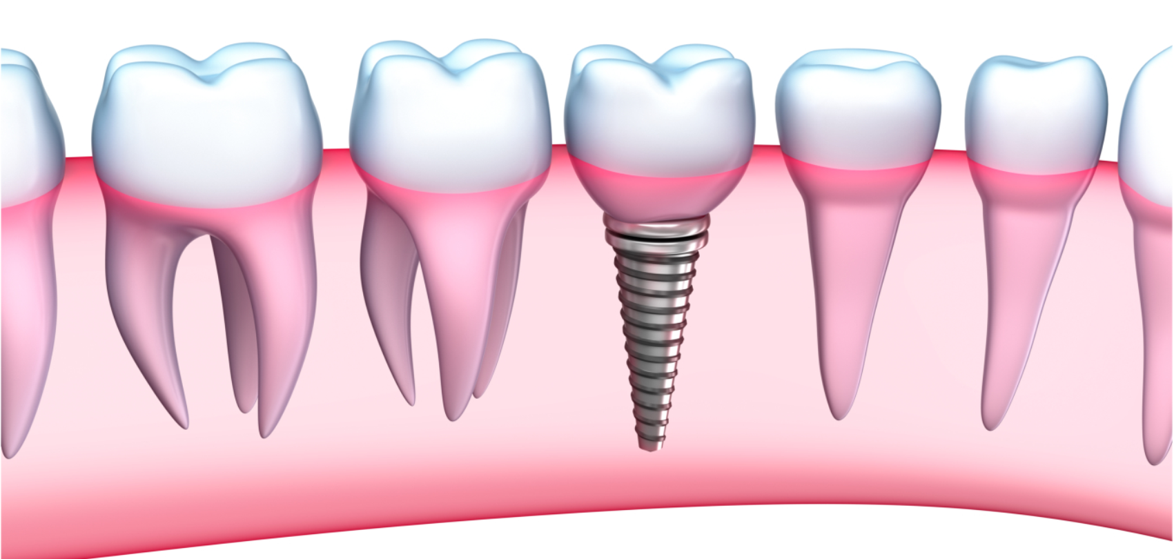 dental implants lewisville
