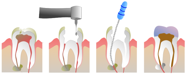 Root Canal in Lewisville